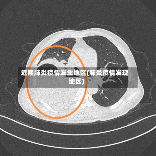 近期肺炎疫情发生地区(肺炎疫情发现地区)-第3张图片