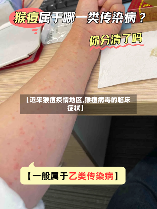 【近来猴痘疫情地区,猴痘病毒的临床症状】-第3张图片